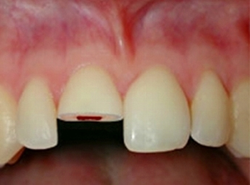 A1-2. 出っ歯の場合、飛び出している前歯をぶつけて折れたり抜けたりするリスクが高まります。このような事故を未然に防ぐ事も矯正治療の役目です。