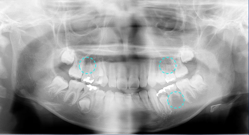A1-3.先天性欠損と呼ばれる、大人の歯（永久歯）の本数が、生まれつき歯少ないことが原因で歯並びなどが悪くなることもあります。