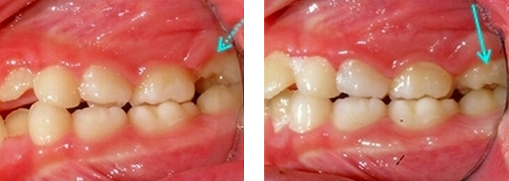 A1-4. 歯が生えてくる方向が異常で、隣の歯に引っかかってしまうこともあります。