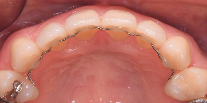 矯正後のリテーナーについて | スウェーデン矯正歯科